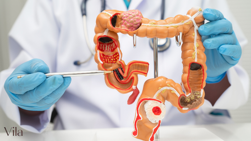 Nervozna creva, simptomi, lečenje i ishrana